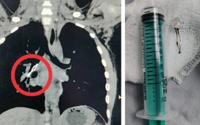 Led Bulb removed from kid’s lungs