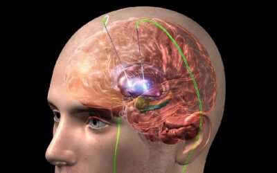 Deep Brain Stimulation Performed to Alleviate Symptoms in a Parkinson’s Patient